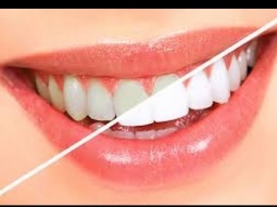 تبيض الاسنان فى المنزل بطريقة بسيطة مضمونة ;) astuces pour blanchir les dents naturellement