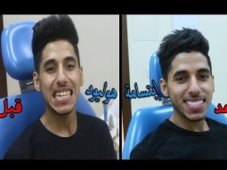 شكرا أضواء الأبتسامة على الأبتسامة الجديدة