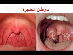 سرطان الحنجرة الأعراض والعلاجات