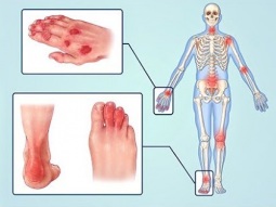 هشاشة العظام والتهاب المفاصل - الأطعمة المسببة