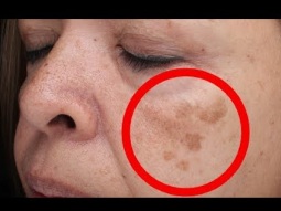 علاجات طبيعية لفرط تصبغات الوجه البنيه