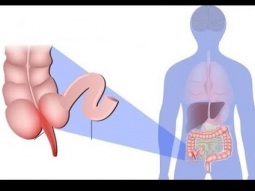 أعراض واسباب التهاب الزائدة الدودية Appendicitis Symptoms