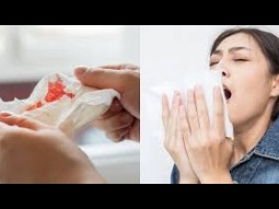 خروج دم خفيف من الانف مع. المخاط