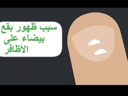 ما معنى وجود نقط بيضاء على الاظافر