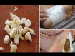 اصنعى بنفسك ضمادة القدم التي تقضي على سموم الجسم نهائيا بمكونات طبيعية