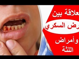حقائق حول مرض السكري وأمراض اللثة
