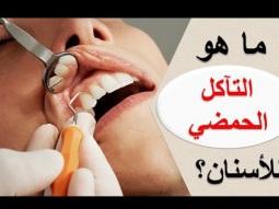 ما هو التآكل الحمضي للأسنان؟