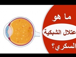 ما هو اعتلال الشبكية السكري؟