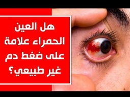هل العين الحمراء علامة على ضغط دم غير طبيعي؟