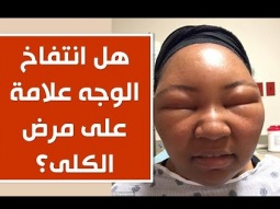 هل انتفاخ الوجه علامة على مرض الكلى؟