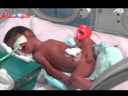 المستشفى غير مجهز والأب مطالب بمليون سنتيم لليلة.. ولادة 4 توائم في كازا